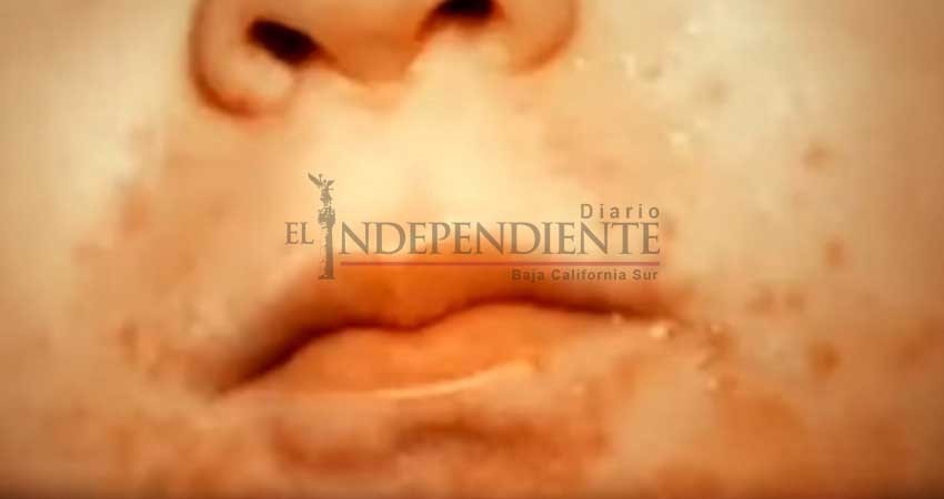 Escuelas en Tulancingo suspenden clases por brote de coxsackie