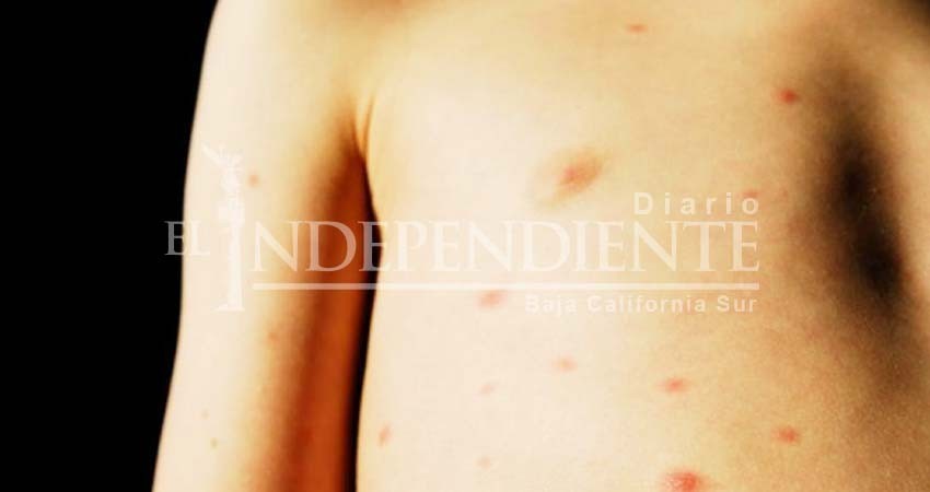 Epidemia de sarampión no llegará a La Paz, asegura jurisdicción sanitaria