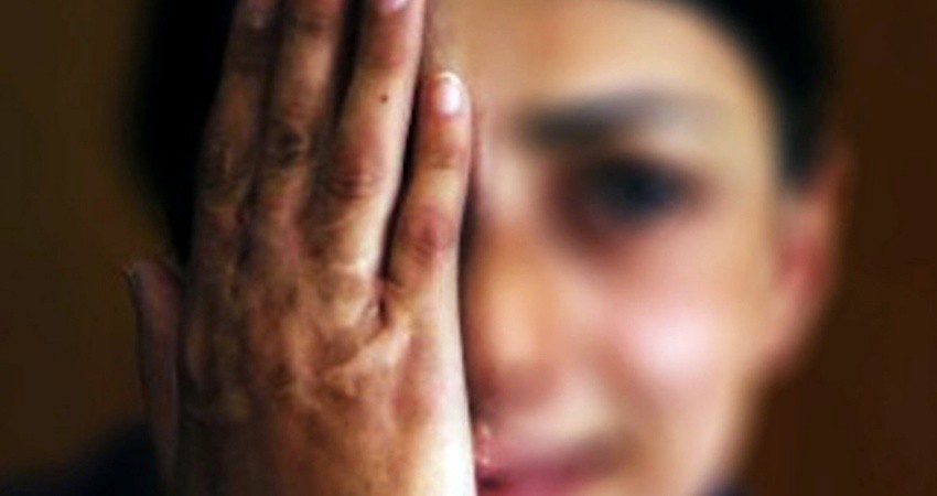 Hasta 14 años de prisión a quien provoque lesiones a las mujeres con ácidos o substancias corrosivas en BCS