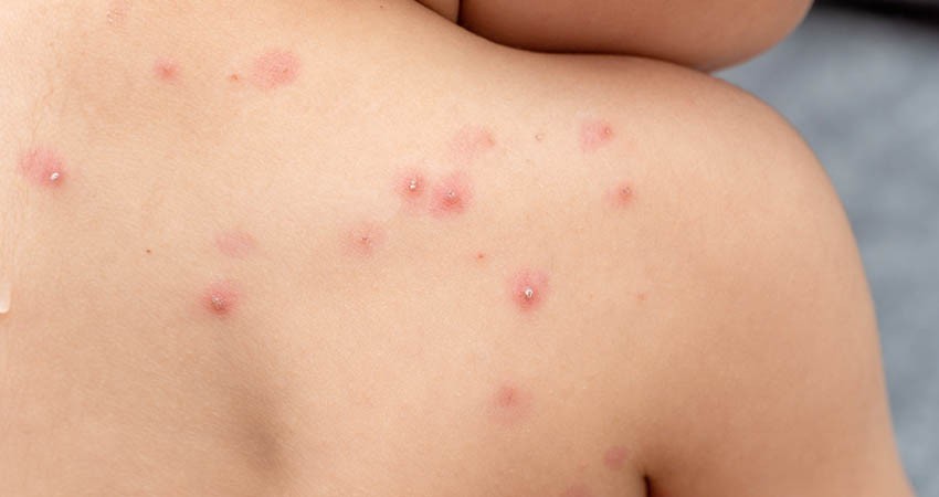 No hay casos de viruela del mono en México: SSA