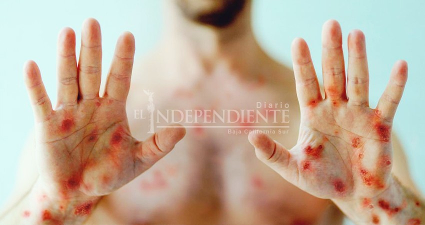 Confirman el primer caso de viruela símica en BCS