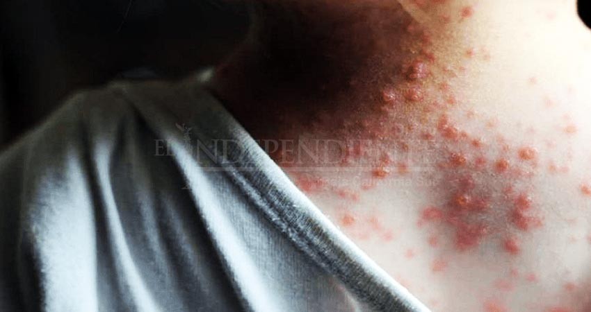 Aumentan casos de sospecha de viruela del mono en BCS