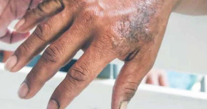 La lepra aún no se ha erradicado en México, pero se puede evitar su contagio: UNAM