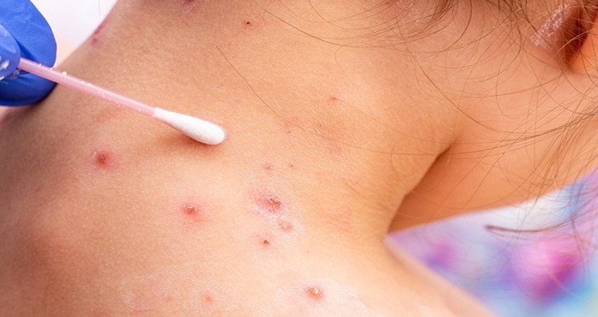 Análisis de laboratorio confirma nuevos casos de Viruela del Mono en BCS