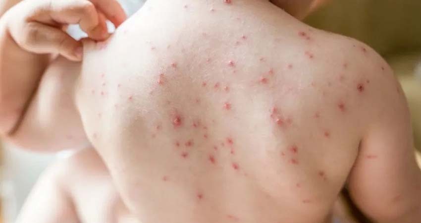 Sarampión enciende alarmas en México