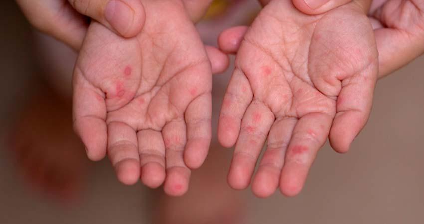 Confirma Secretaría de Salud nuevos casos de sarampión en Ciudad Insurgentes