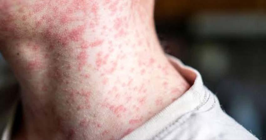 México espera erradicar casos de sarampión en el país en noviembre: Salud