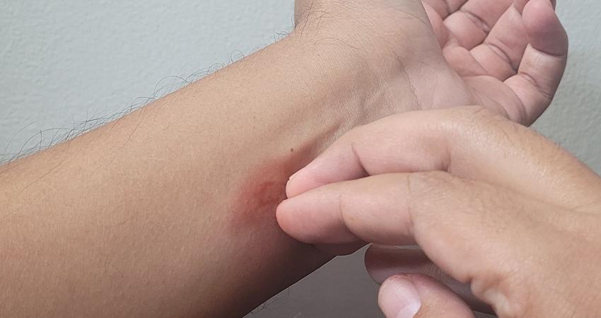 Llaman a la población a estar alerta ante síntomas por dengue y no automedicarse