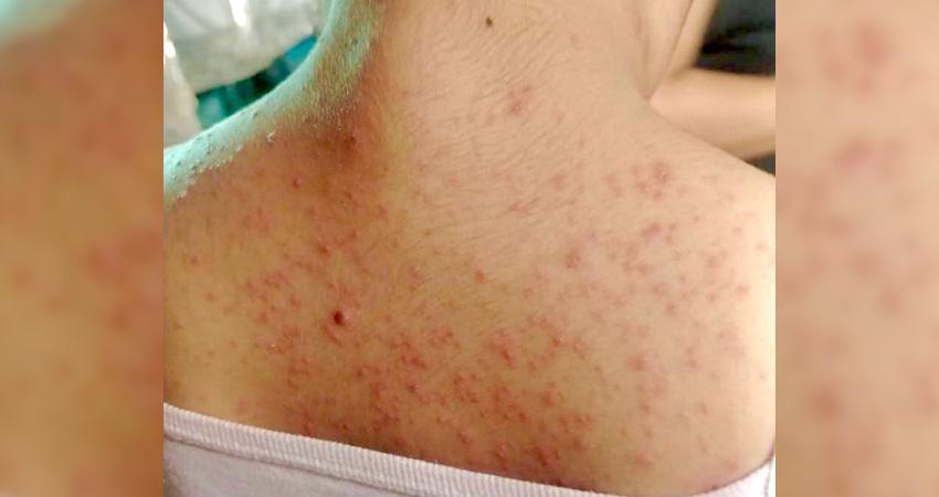 Registra Los Cabos el primer caso de Sarampión del año