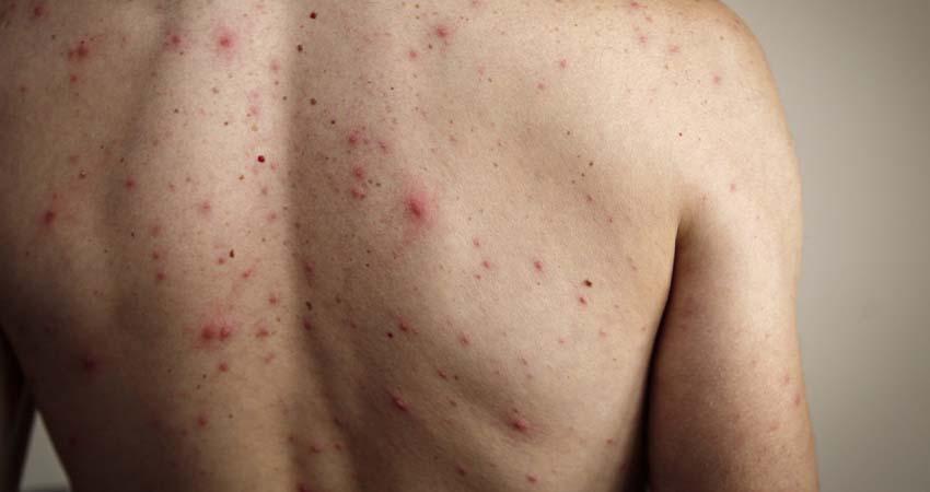 Suman 31 muertes por sarampión; más de 2 mil niños contagiados