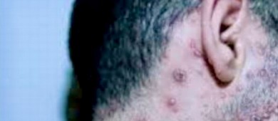 Confirman 6 casos sospechosos de viruela símica en BCS