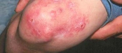 La lepra aún no se ha erradicado en México, pero se puede evitar su contagio: UNAM