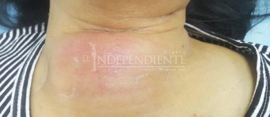 Emite la SSA recomendaciones preventivas para evitar futuros brotes de Melioidosis