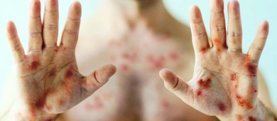 Secretaría de Salud emite estas recomendaciones sobre el mpox