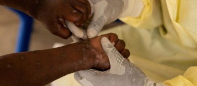 Alertan por variante más letal y contagiosa de la viruela del mono