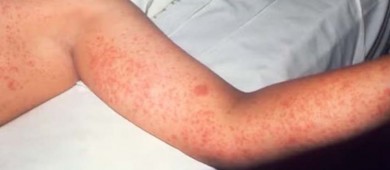 Sarampión enciende alarmas en México