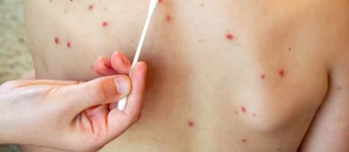 Aumentan casos de sarampión en México; suman 126