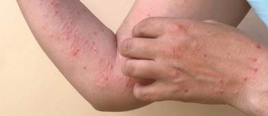 Se disparan casos de viruela del mono en México; suman 174