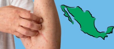 México reporta cuatro muertes por sarampión y mil 629 contagios en 2025