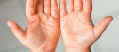 Aumentan casos de sarampión y tos ferina en México, alerta el PUIREE