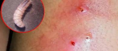 Gusano barrenador cobra su primera víctima humana en México