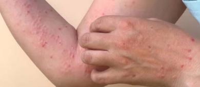 Brote de sarampión sigue en aumento en México