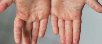 Se extienden casos de coxsackie; registran brotes, al menos, 63 municipios