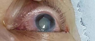 Cataratas en aumento: vejez y diabetes elevan el riesgo de ceguera en México