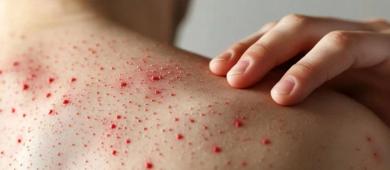 Sarampión en México: Salud confirma la primera muerte en 2026