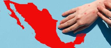 PAN culpa a gobiernos de Morena por brotes de sarampión