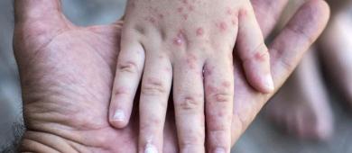 Suman 31 muertes por sarampión; más de 2 mil niños contagiados