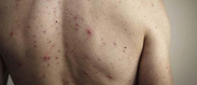 El Mundial podría provocar nueva oleada de casos de sarampión en México, alertan expertos