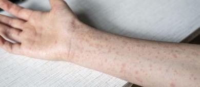 Dos nuevas muertes por sarampión elevan a 33 los decesos por brote en México