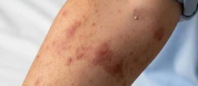 México, epicentro del brote de sarampión en América